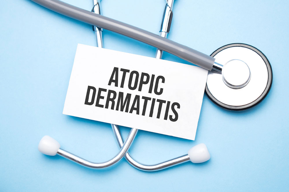 Top 9 Remedies for Atopic Dermatitis