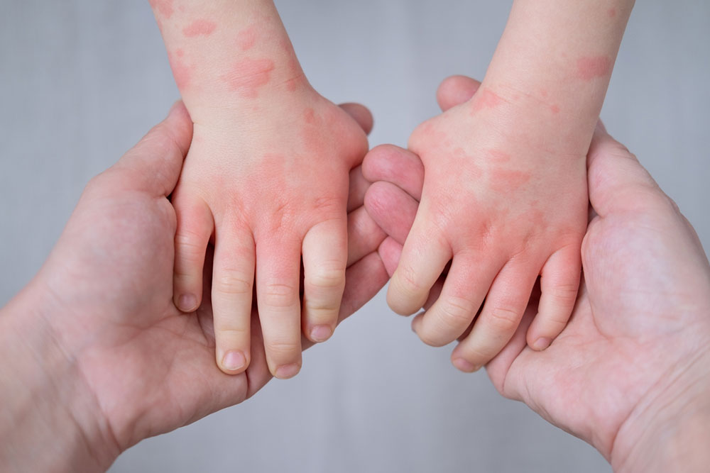 Atopic dermatitis management in children