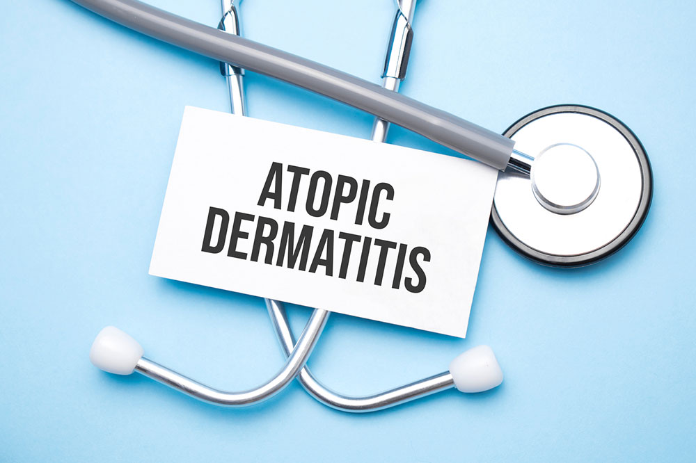 Atopic Dermatitis &#8211; Symptoms, Causes, and Remedies