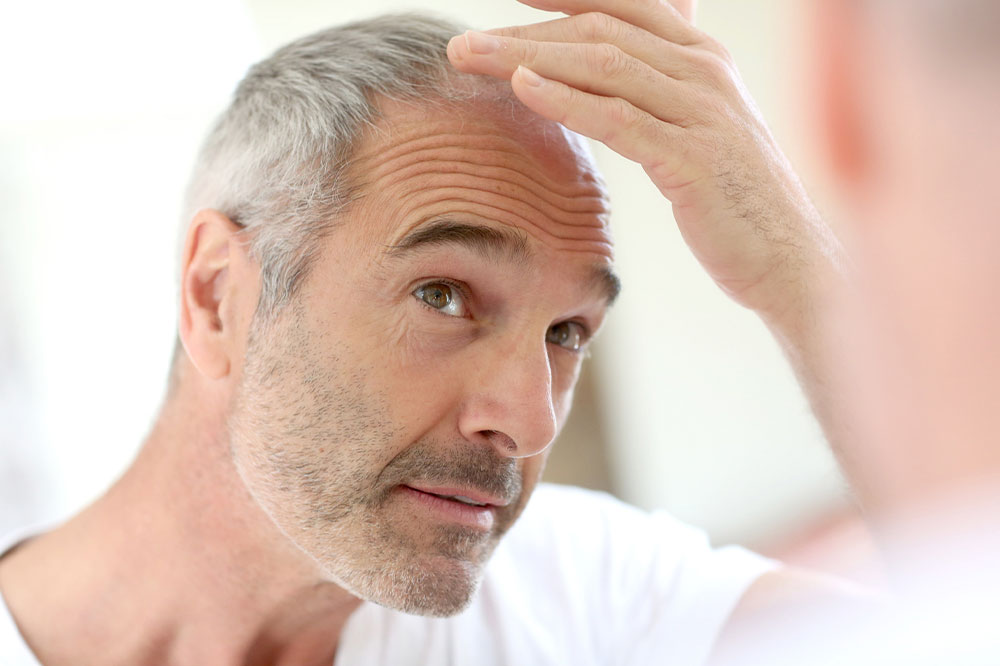 Hair loss &#8211; Types, causes, and foods that promote healthy growth